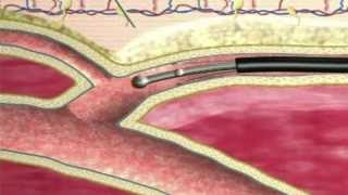 Venous Disease and Endovenous Ablation