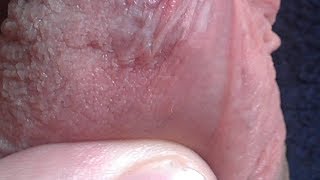 What Happens If You Pop Pearly Penile Papules?