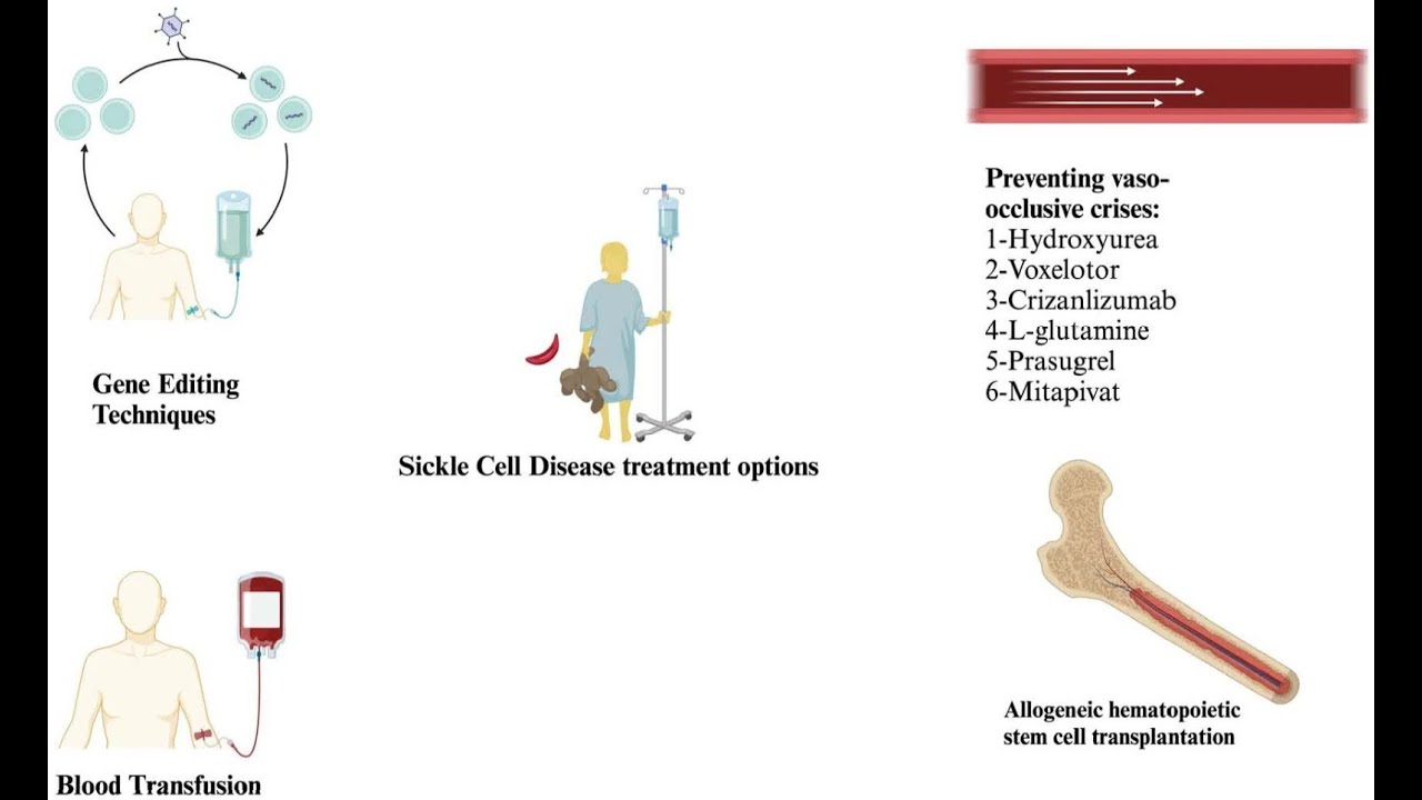 Варианты лечения серповидноклеточной анемии