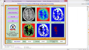 Brain Tumor Detection Using Image Processing Matlab Project Code
