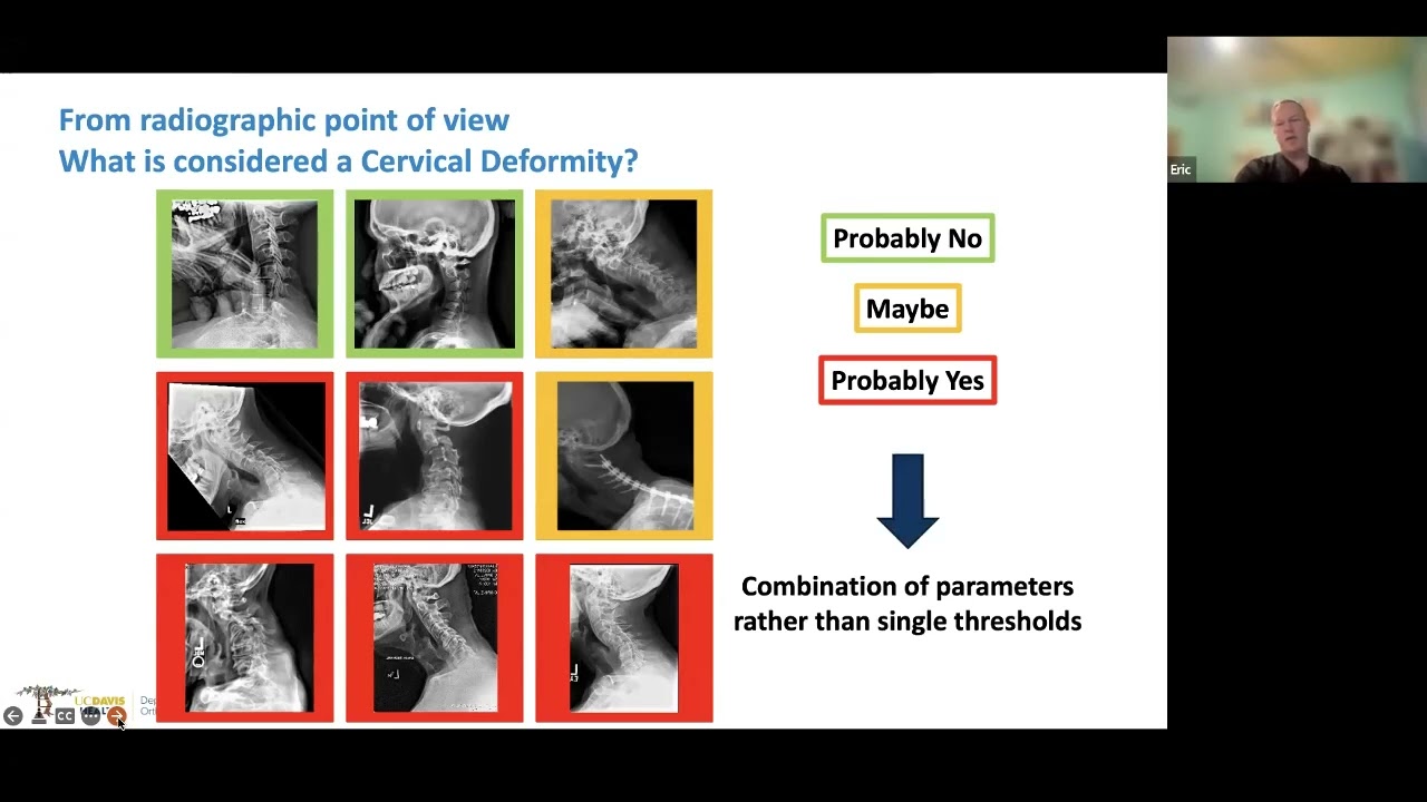 Деформация шейного отдела позвоночника, представленная доктором Эриком Клайнбергом