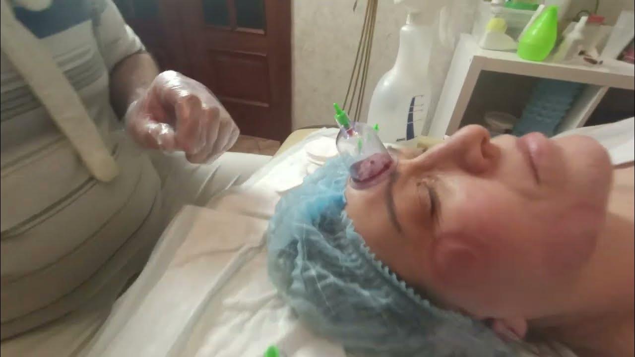 Ставим банки на лицо для омоложения! Процедура Косметическая Хиджама от ...