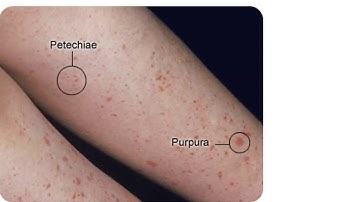 Platelet Disorders- An Overview