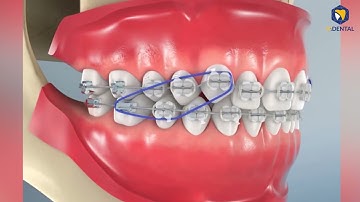 Thun liên hàm trong niềng răng có tác dụng gì?