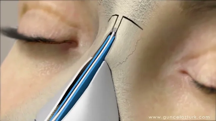 Rhinoplasty (nose job)animation by dr Guncel Ozturk