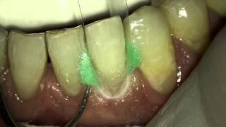 cervical adaptation