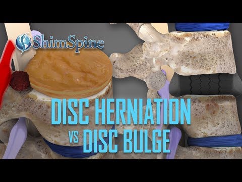 Herniated Disc - DePuy Videos. 