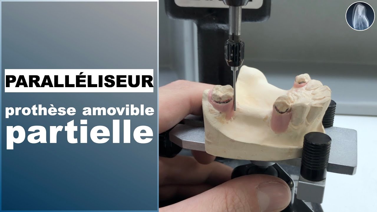 Mise de dépouille parfaite pour prothèse amovible partielle : Technique simple et efficace !