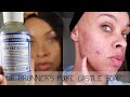 I TRIED DR BRONNER'S PURE CASTILE SOAP FOR ONE WEEK - ACNE PRONE SKIN