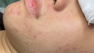 Linh My Đặng Spa - Nặn mụn Relax 06/04/2024 part 1 Hidden Acne