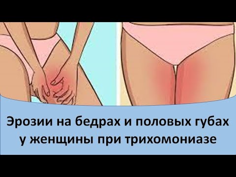 Эрозии на коже бедер и половых губах у женщины при трихомониазе