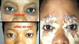 IN 10 MINUTES REMOVE DARK UNDER-EYE GET RID OF DARK CIRCLES FAST