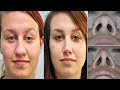 Make Fat Nose Thinner Without Surgery!! Slim Down your Nose Remove Nose fat