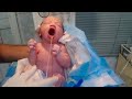 New born baby inhale meconium and amniotic fluid take action remove all by suction clean baby 