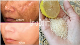 HOW TO REMOVE STUBBORN AND LONG-LASTING BLACK SPOTS NATURALLY AND QUICKLY.!!