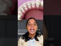 Why Permanent Retainers Are Important? | Dental Care Tips