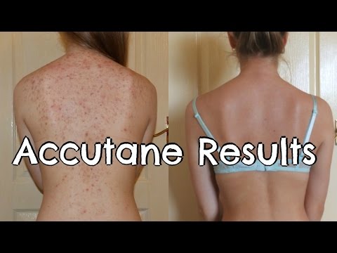 How I Got Rid of My Acne | Accutane Results