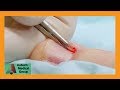 Double Toe Procedure with Partial Nail Removal | Auburn Medical Group