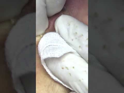 Full blackhead acne-hidden acne.mụn ẩn sâu-khó nặn