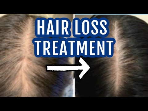 Spironolactone for hair loss| Dr Dray