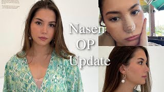 NasenOP Update | 1 Jahr Post OP | Shirin Cherie