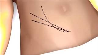 #02 Medical news for Cambodia (ការផ្លាស់ប្តូរតម្រងនោម -Kidney Transplant)