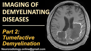 Imaging of Tumefactive Demyelination.