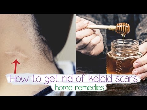 how to get rid of keloid scars Fast | Home remedy 💚