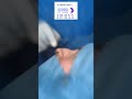Rhinoplasty Before &amp; After