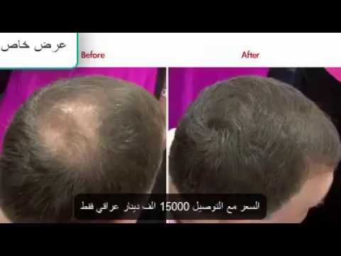 مكثف الشعر الفوري وخلال دقيقة واحدة