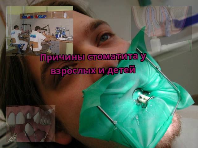 Причины стоматита у взрослых и детей