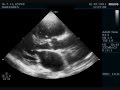 FLAIL MITRAL LEAFLET - ECHOCARDIOGRAPHY SERIES BY DR.ANKUR.K.CHAUDHARI