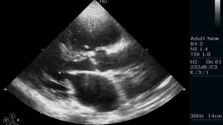 FLAIL MITRAL LEAFLET - ECHOCARDIOGRAPHY SERIES BY DR.ANKUR.K.CHAUDHARI