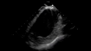 Catheter Ablation Of Ventricular Tachycardia Vt In Patients With Left-Sided Mechanical Valves