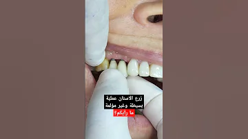 زرع الاسنان عملية بسيطة 