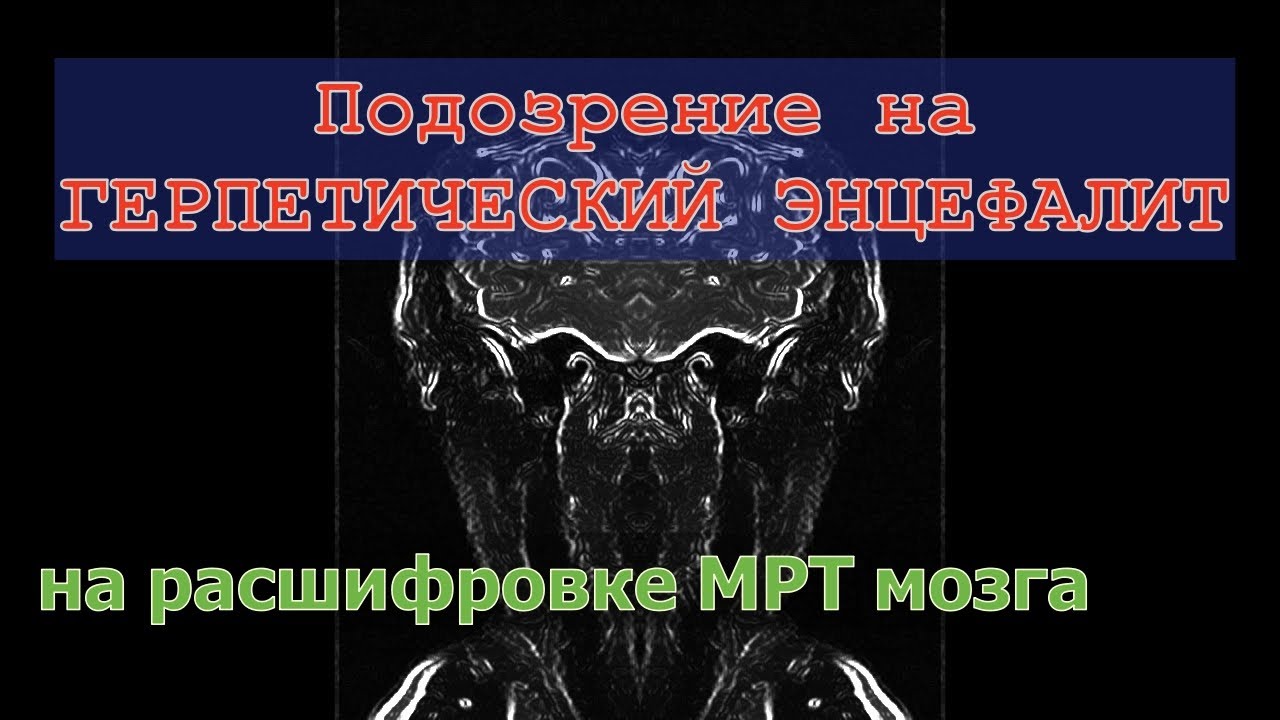 ДИФФУЗНОЕ ПОРАЖЕНИЕ головного мозга   подозрение на ГЕРПЕТИЧЕСКИЙ ЭНЦЕФАЛИТ на расшифровке МРТ