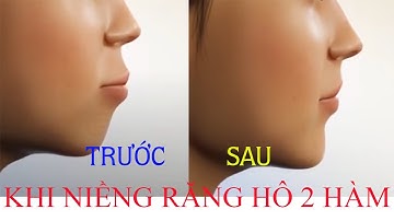 nhakhoaviety:Niềng răng hô 2 hàm,nhổ 4 răng số 4.