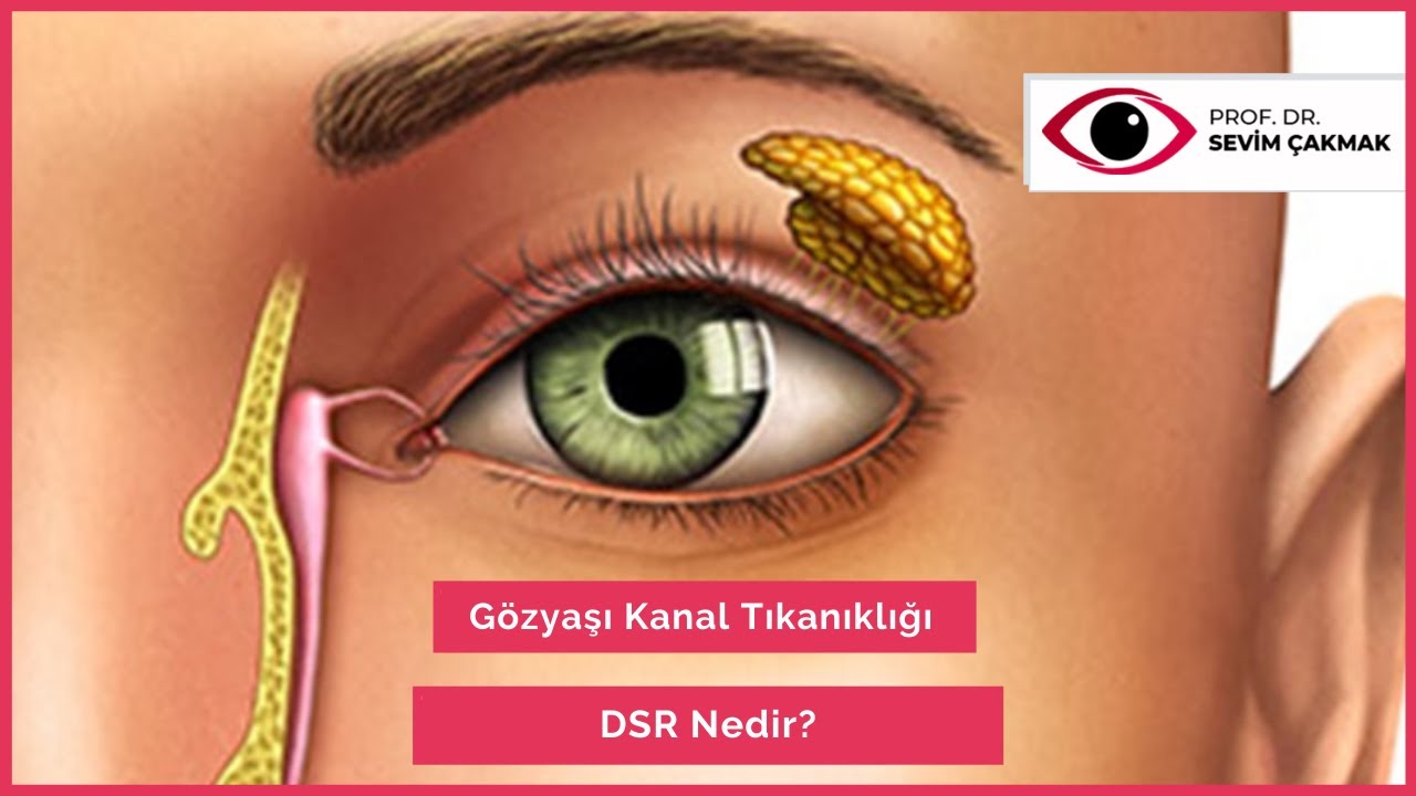Gözyaşı Kanal Tıkanıklığı | DSR Nedir? | Gözyaşı Kanal Tıkanıklığı Nedir? | Prof.Dr.Sevim Çakmak