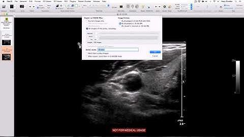 How to get rid of patient name or unwanted annotation from medical images imported into OsiriX Lite