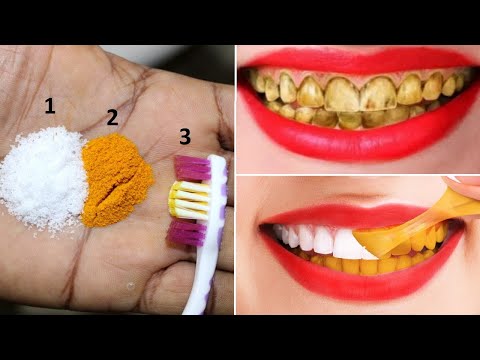 تصویری: آیا سفید کردن دندان به مینای دندان آسیب می رساند؟