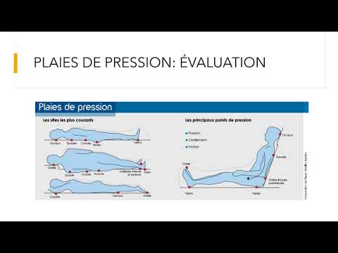 Vidéo: Ulcères De Pression - Causes, Degrés, Lieux De Formation, Traitement, Prévention
