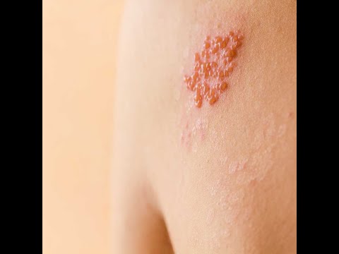 Urticaria alergică – o provocare pentru medic și pacient