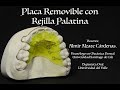 Placa removible con rejilla palatina