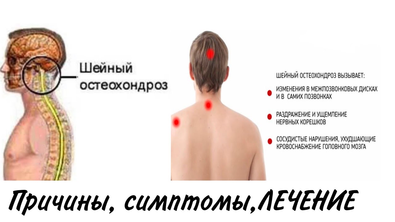 Шейный остеохондроз лечение у женщин после 40. Остеохондроз шейного отдела симптомы. Симптомы при остеохондрозе шейного. Симптомы остеохондроза шейного отдела позвоночника. Шейный остеохондроз симптомы у женщин симптомы.