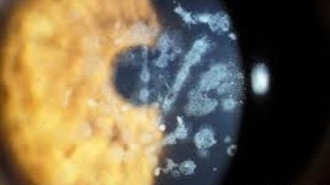 Stromal Dystrophies; Granular Corneal, Lattice Corneal, Macular Corneal Dystrophy