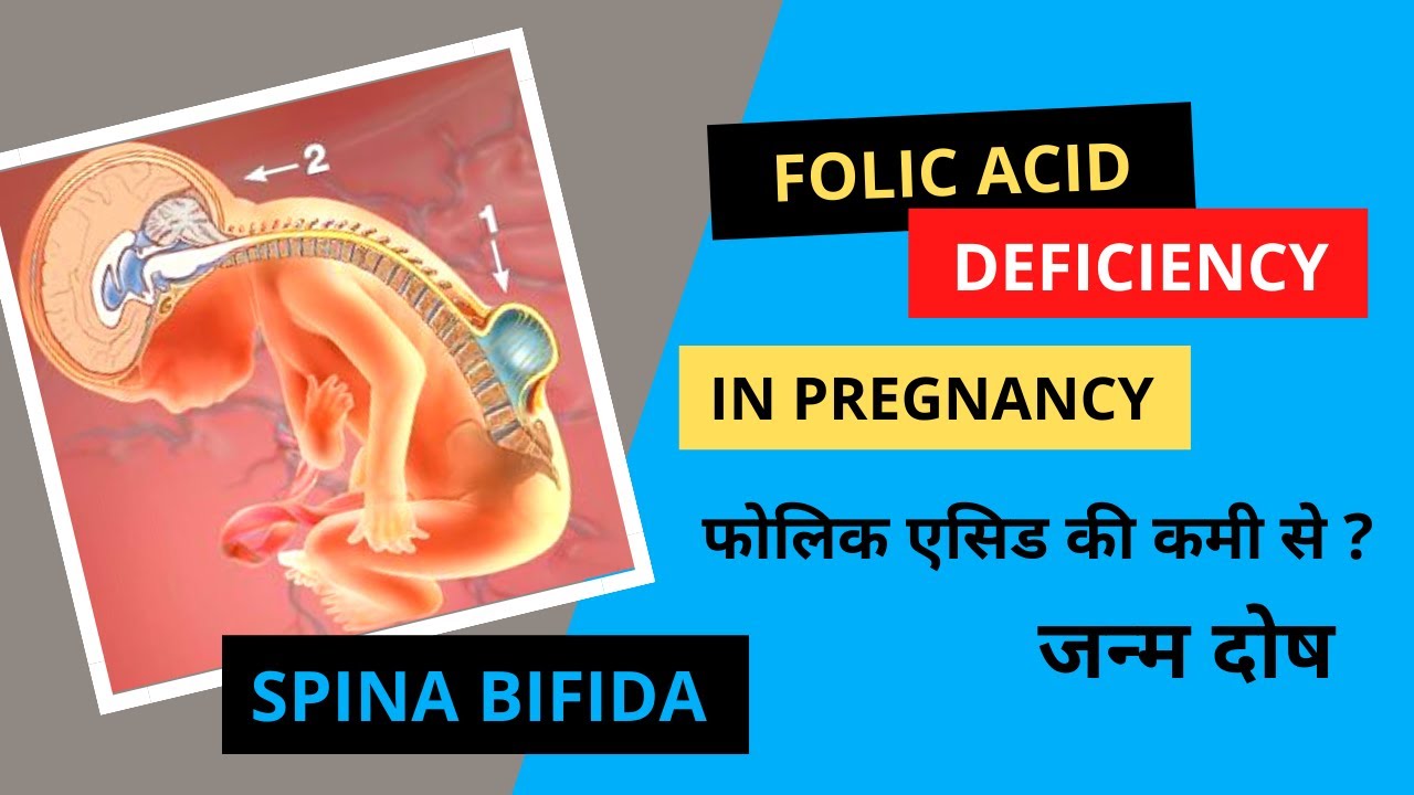 Folic Acid ki Kami se kya hota hai? Folic Acid Deficiency? SpinaBifida YouTube