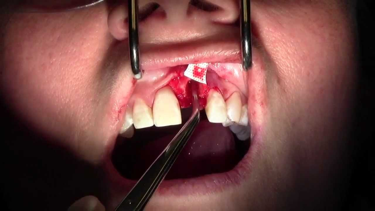 Extraction #9 with GBR-Socket Grafting, Full Video, II