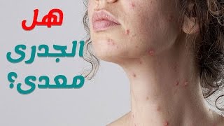 اعراض وعلاج الجدري المائي عند الكبار وطرق الوقاية