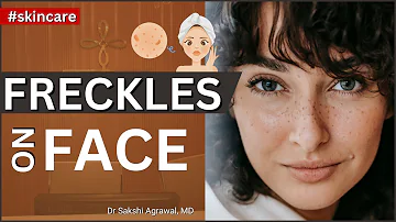 Freckles Treatment | Freckles laser treatment | Freckles removal cream | Freckles | Freckles on Face