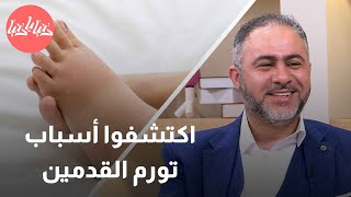 لماذا يحدث تورم القدمين؟ وكيف يمكن التعامل مع هذه المشكلة؟